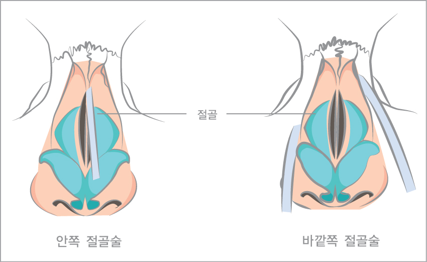 절골술