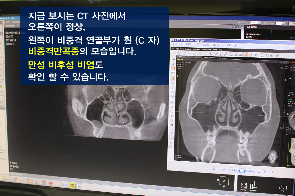 Ai3Ha2JoOcrFMhKE_20160504.png 코성형