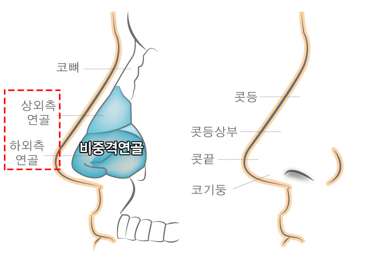 비중격만곡증