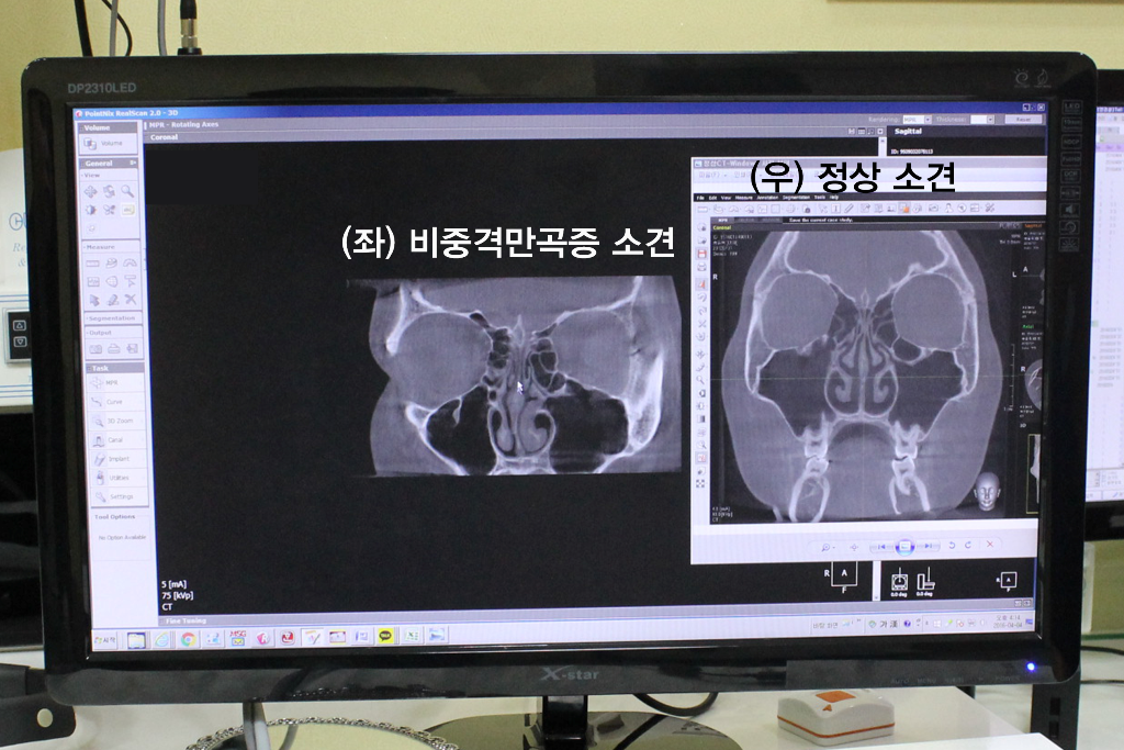 비중격 만곡증