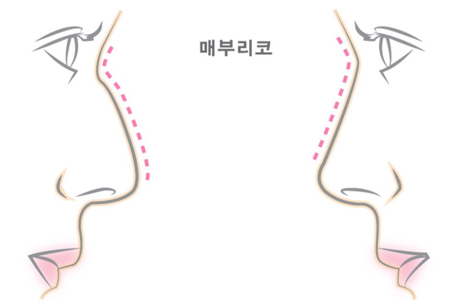 매부리코모양