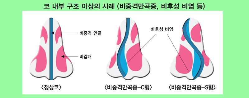 JGlYpFT1cbi2If0A_20170214.png 비중격만곡증 증상