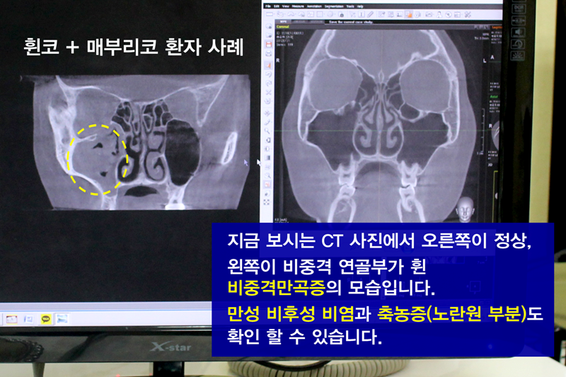 v3FkIW8bHP0aCSDm_20170214.png 비중격만곡증 증상