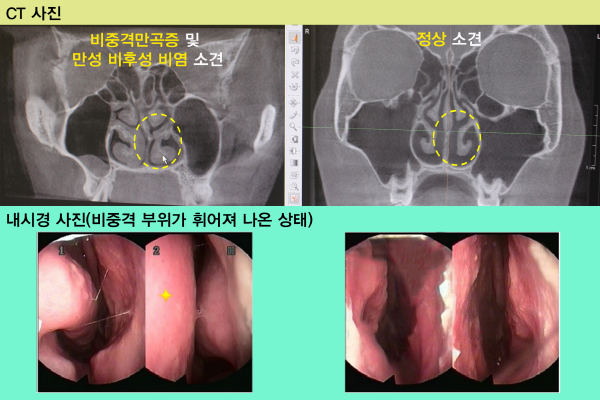 AiLU5xEc87fjKed9_20170322.png 비염 수술