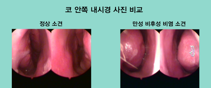 b0qkcrefj4mdBnWi_20170322.png 비염수술
