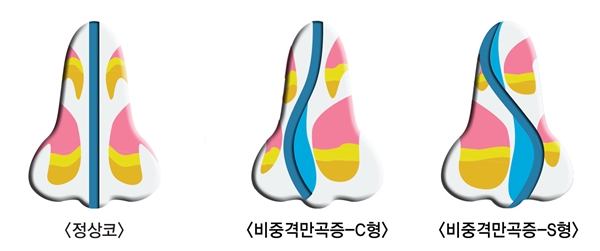 q8iDhIXfC5NVJsW9_20171127.jpg 코재수술