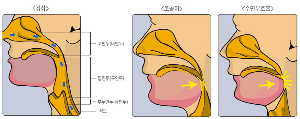 z9pwJR8O25Yirhkm_20171213.jpg 코골이