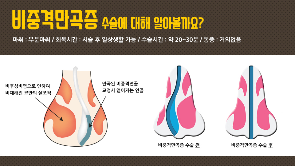 4REeMqs1aLBGivwW_20180228.jpg 코막힘