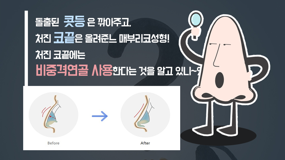 rBkwIJVvc2zUliO4_20180307.jpg 여자매부리코