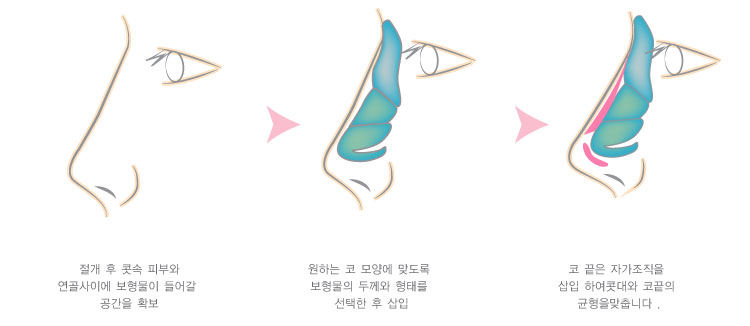 AvcW16dOZykexVhf_20180316.jpg 비중격 코성형