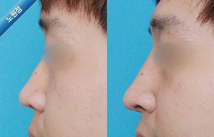 휜코교정전후사진 휜코수술전후사진