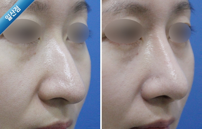 DUFTLy0WxogR9OYP_20200710.jpg 매부리코교정수술전후사진