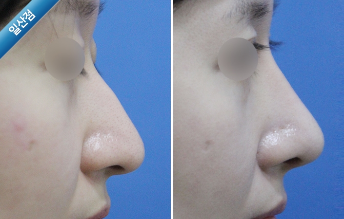 EdcXPzrwUh17N6GI_20200710.jpg 매부리코교정수술전후사진