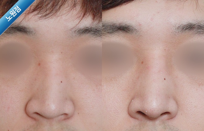 휜코수술전후사진 휜코수술전후사진