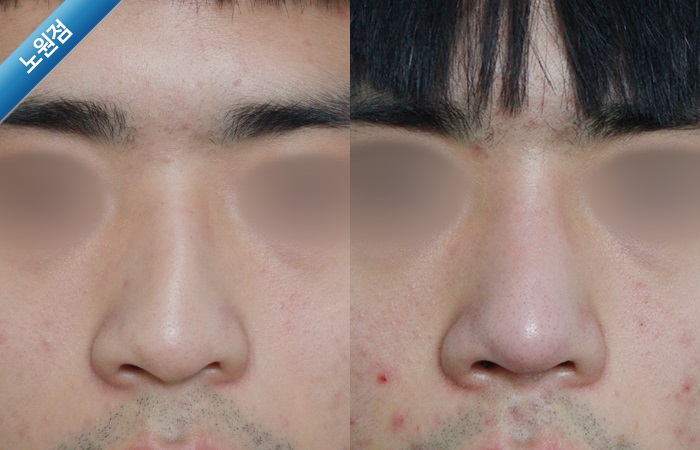 휜코교정전후사진 휜코수술전후사진