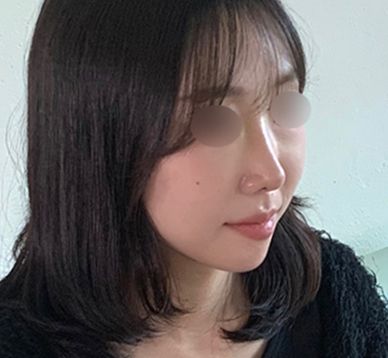 약 없이는 못 살던 비염, 수술 후 일상이 달라졌어요_여자기능코성형