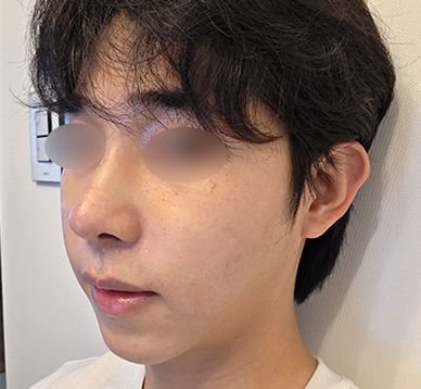 숨 쉬는 게 이렇게 편해질 줄은 몰랐어요!_남자기능코성형
