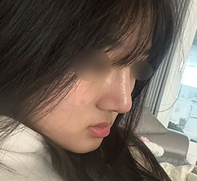 사진 찍기 싫던 옆모습에서 당당해지기까지!_여자기능코성형