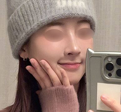 콧물과 코막힘에서 탈출! 자연스러운 코라인까지!_여자기능코성형