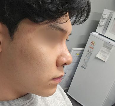 한번의 수술로 코모양 기능 잡았습니다_남자기능코후기