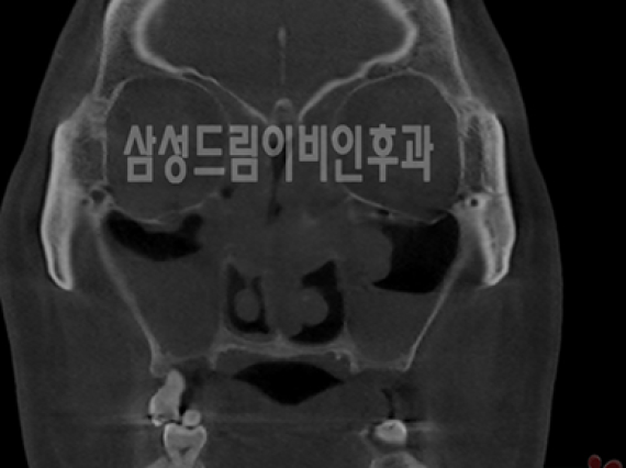 축농증, 수술과 관리는 어떻게 할까?
