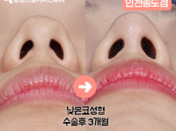 삼성드림이비인후과 인천송도점 : 낮은코성형 전후사진