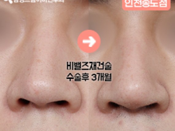 삼성드림이비인후과 인천송도점 : 비밸브재건술 전후사진