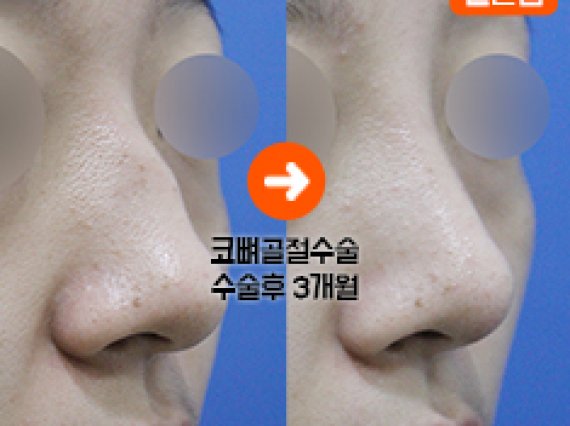 삼성드림 일산점_ 코뼈골절수술 전후사진 자세히보기