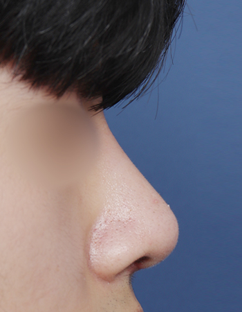  수술 후