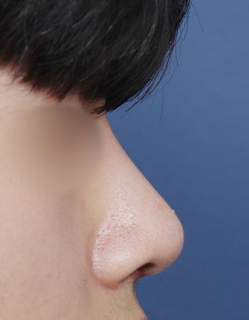  수술 후