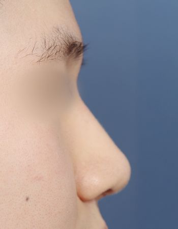  수술 후