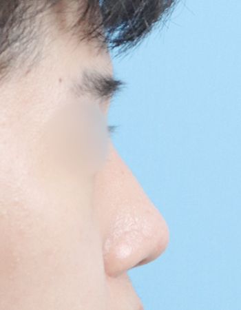 수술 후