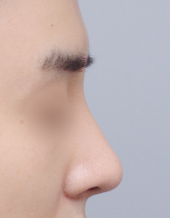  수술 후
