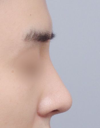  수술 후