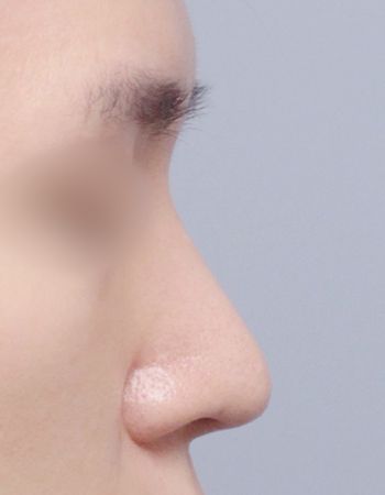  수술 후