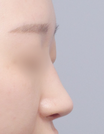  수술 후