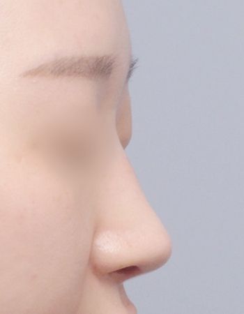  수술 후