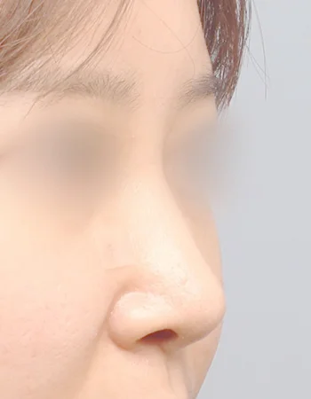  수술 후