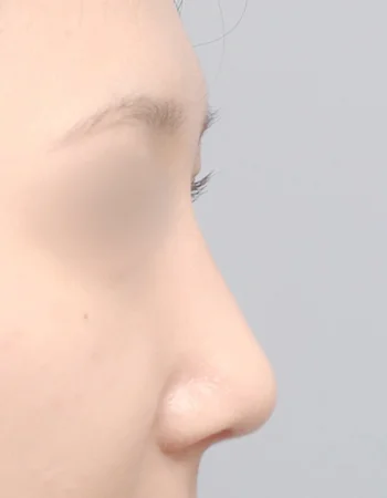  수술 후