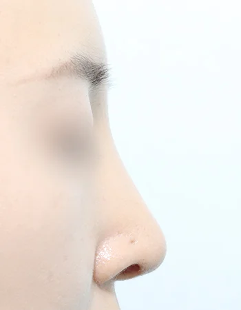  수술 후
