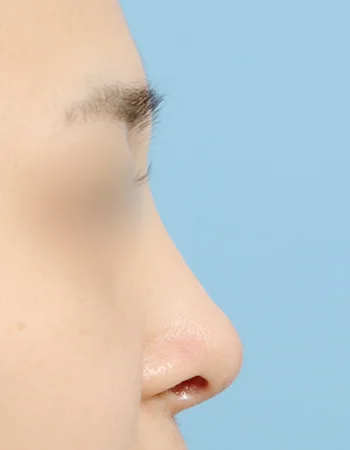  수술 후