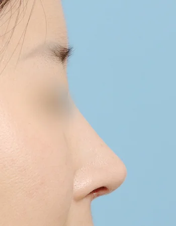  수술 후