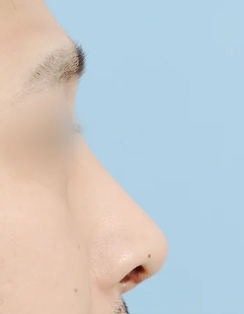  수술 후