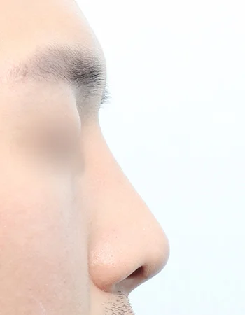  수술 후