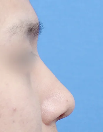  수술 후