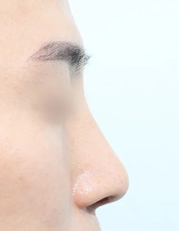  수술 후