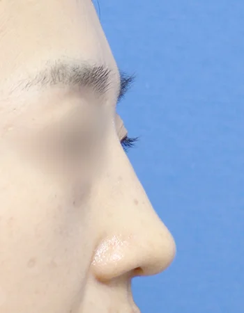  수술 후