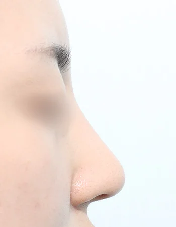  수술 후