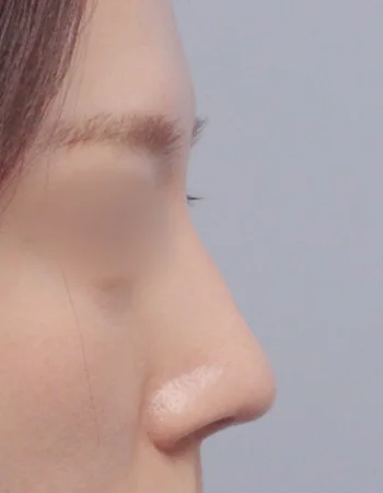  수술 후