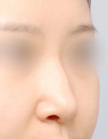  수술 전